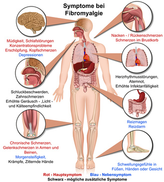 Fibromyalgie Symptome Grafik