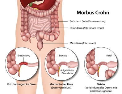 Morbus Crohn heilen