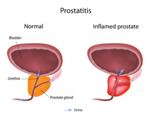 Prostataentzündung